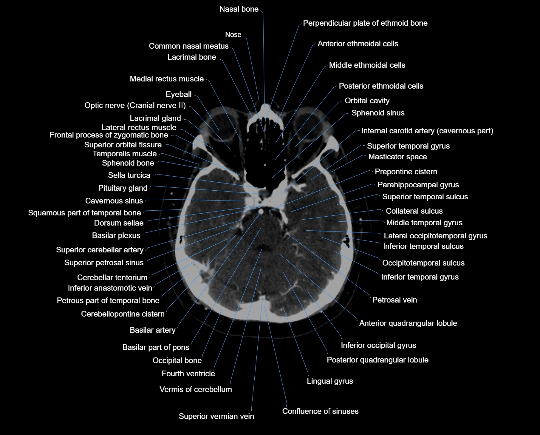 CT scan brain axial labelled cross sectional anatomy image-img-000022.webp